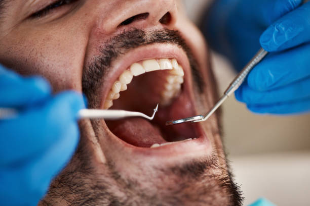 Best Emergency Dental Extractions in Mount Sterling, OH
